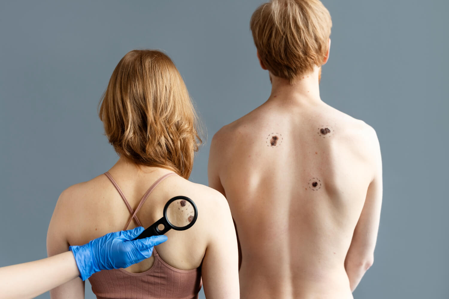 Un uomo e una donna di spalle durante un controllo dermatologico dei nei con lente d’ingrandimento